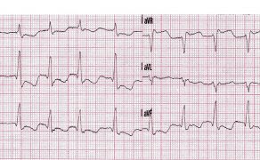 ostry zespół wieńcowy