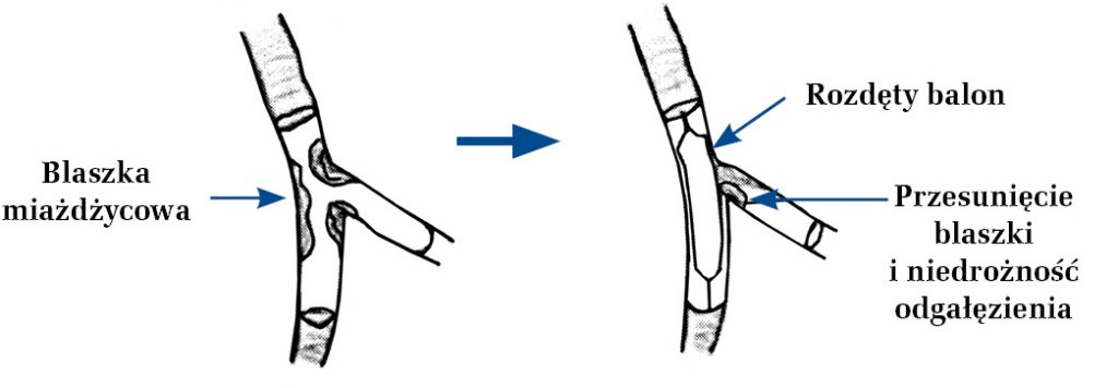 NAR_3_17_HARTOWANIE_SERCA_W_KARETCE_RYC_1