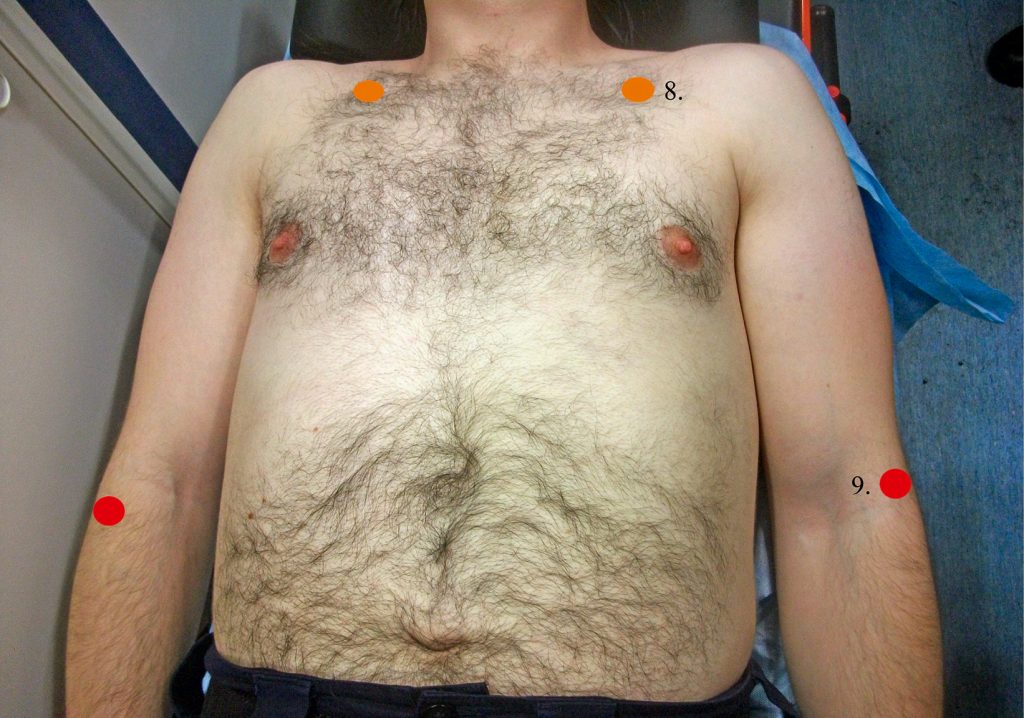 nar_1_20_ZNACZENIA_AKUPRESURY_W_ZWALCZANIU_BOLU_PT_8-9