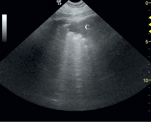 NAR_6_20_wiedza_w_praktyce_DIAGNOSTYKA_ROZNICOWA_PRZYCZYN_DUSZNOSCI_RYC_3_C